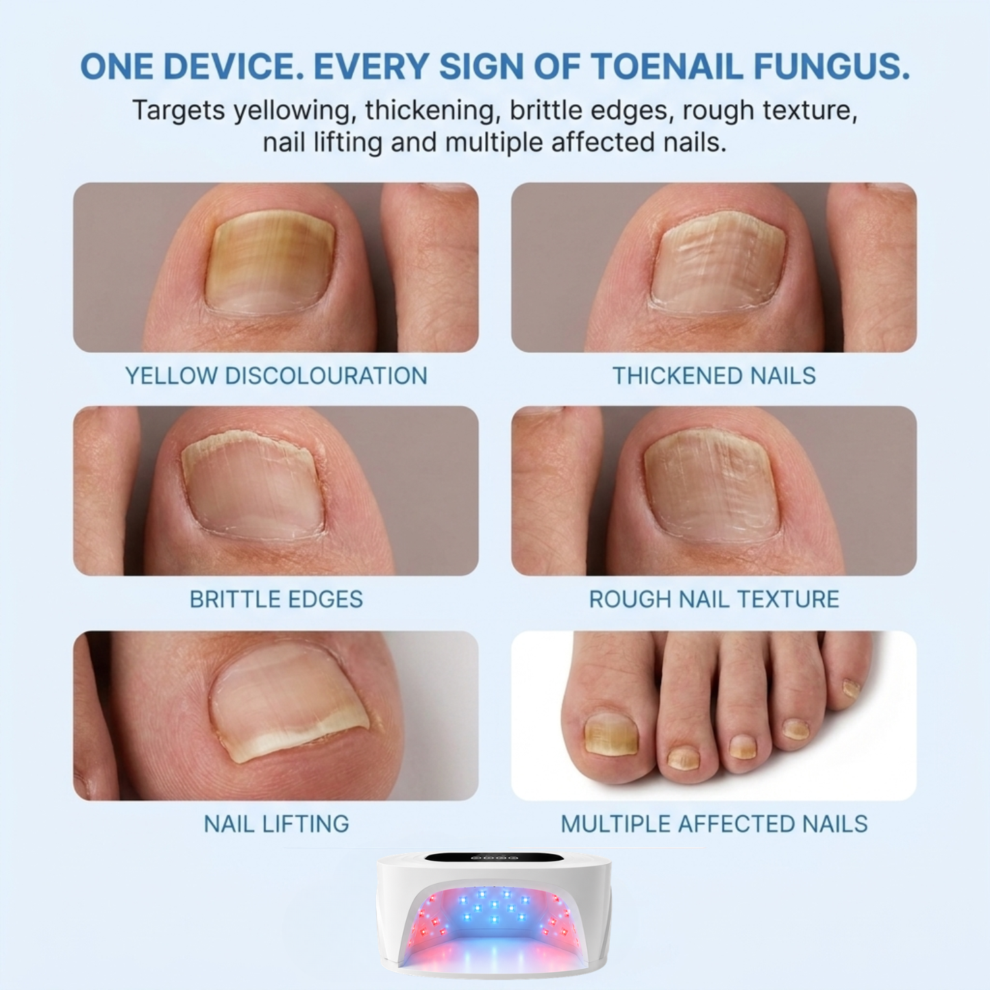 NailRenew — Eliminates Toe Fungus & Restores Healthy Nails